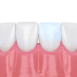 Tooth-colored bonding material being applied to a front tooth