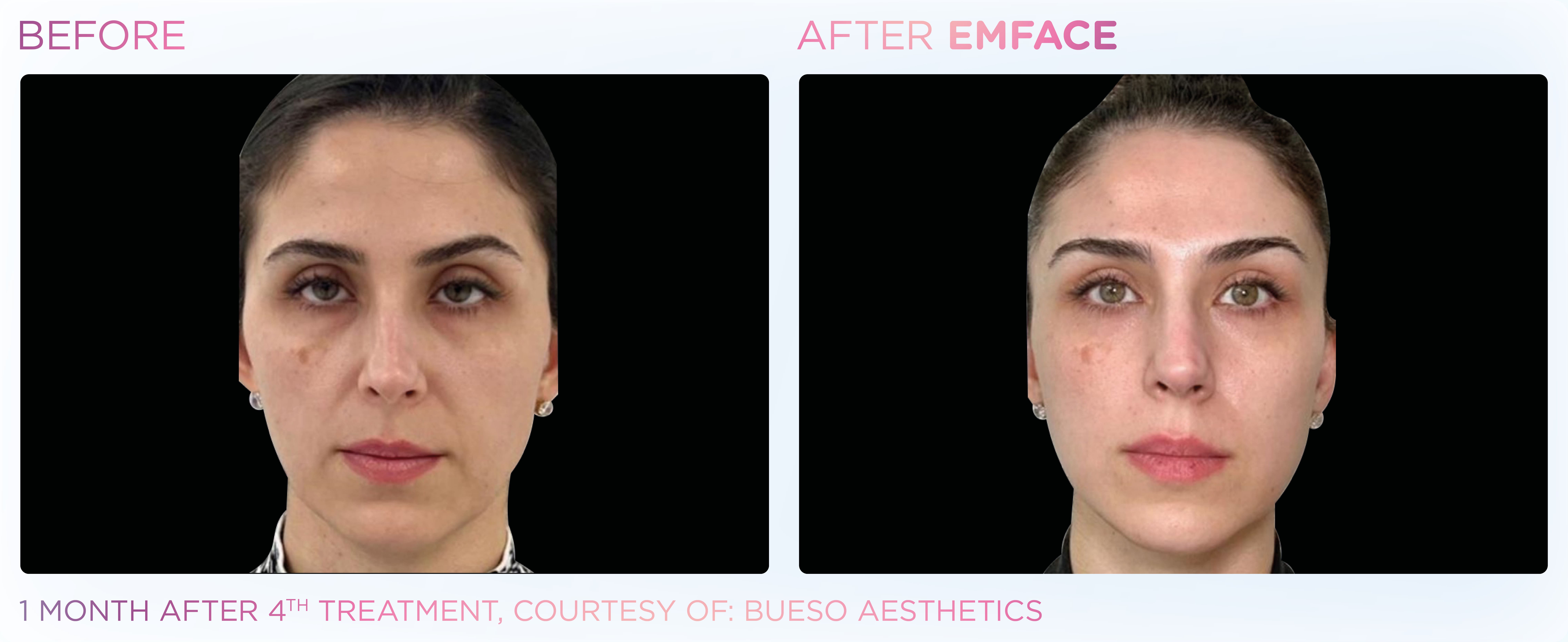 BTL-provided full-face before-and-after comparison one month after the fourth EMFACE treatment