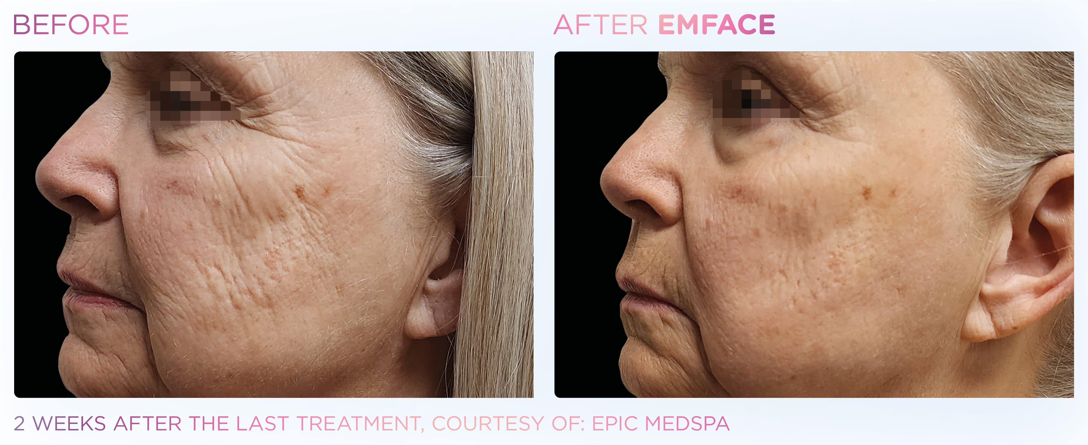 BTL-provided facial before-and-after comparison two weeks after the last EMFACE treatment