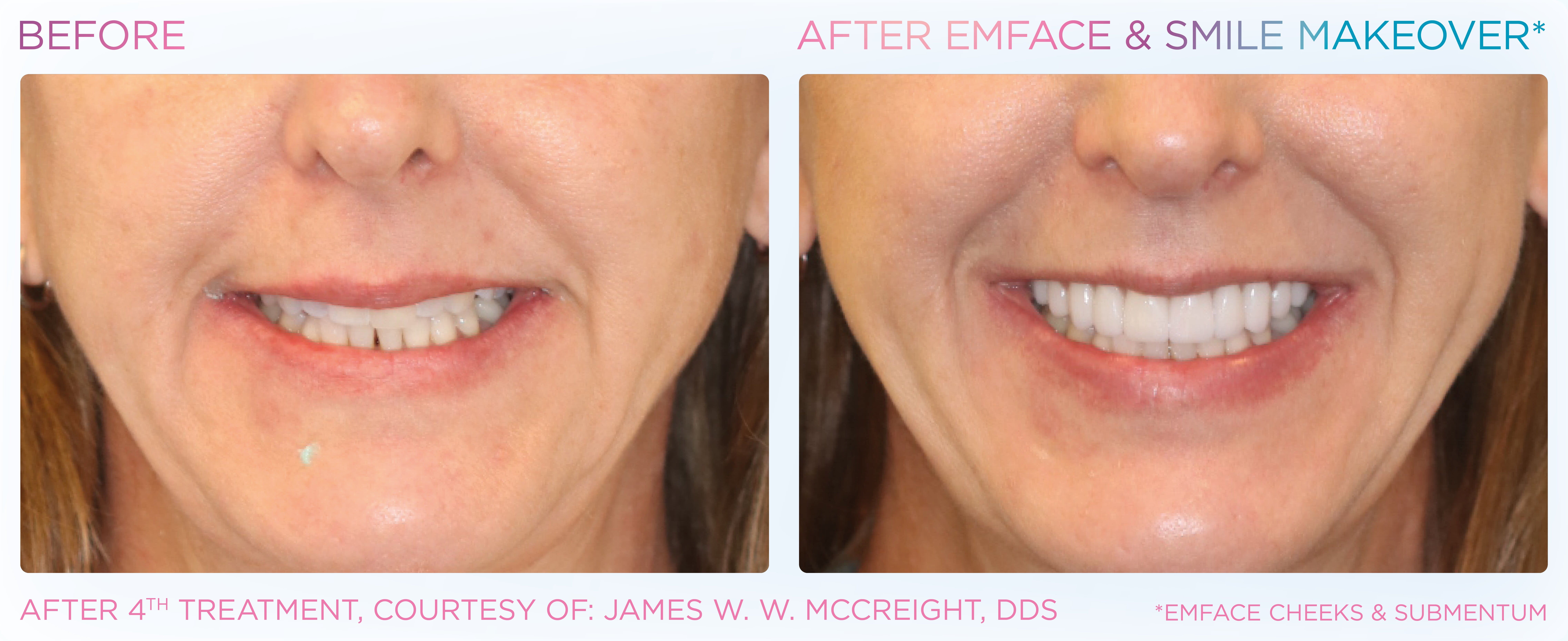 BTL-provided smile before-and-after comparison following combined EMFACE and smile makeover treatment