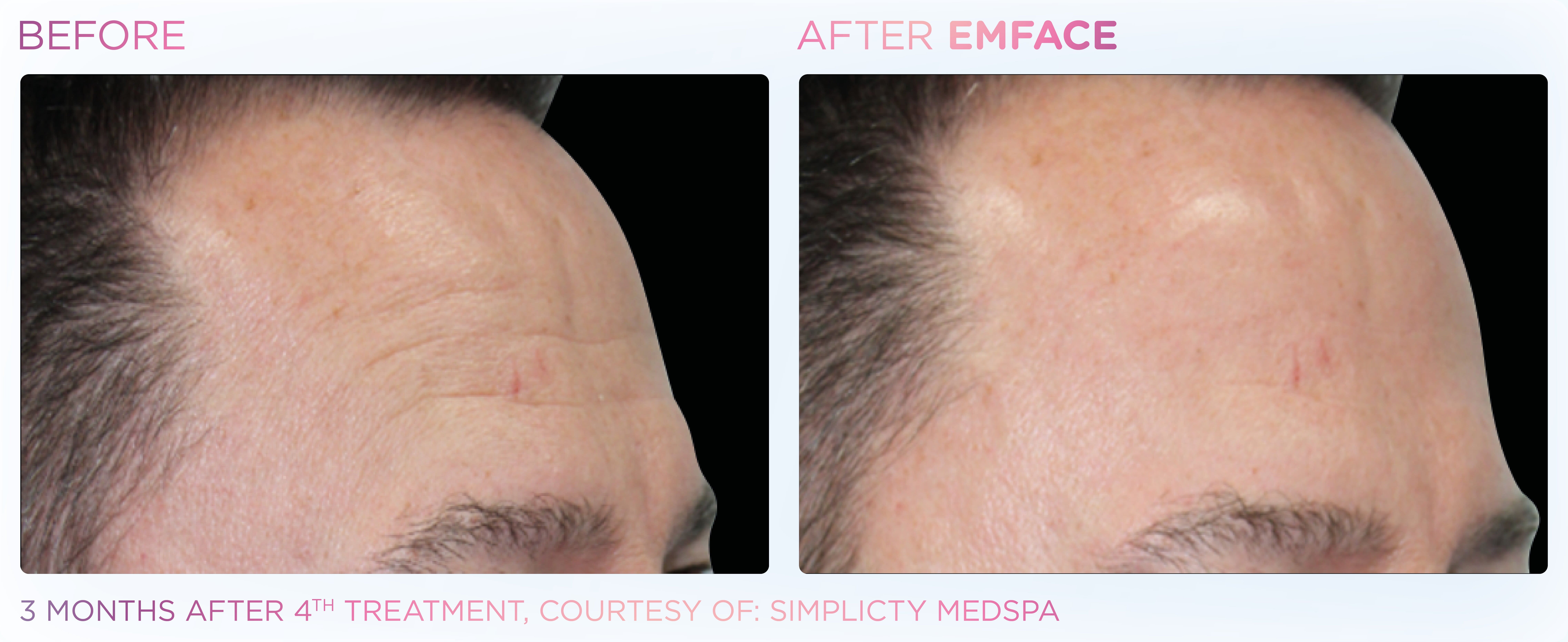BTL-provided forehead before-and-after comparison three months after the fourth EMFACE treatment