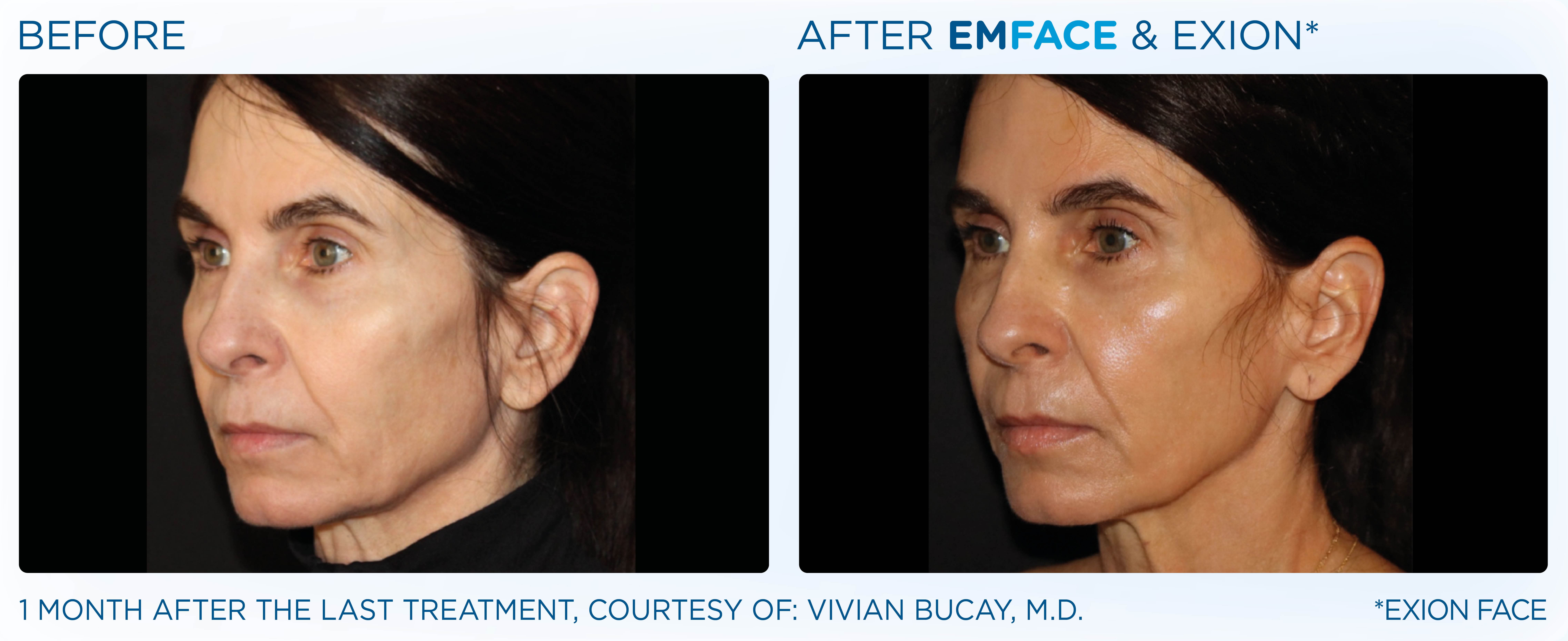 BTL-provided before-and-after facial comparison one month after combined EMFACE and EXION Face treatment