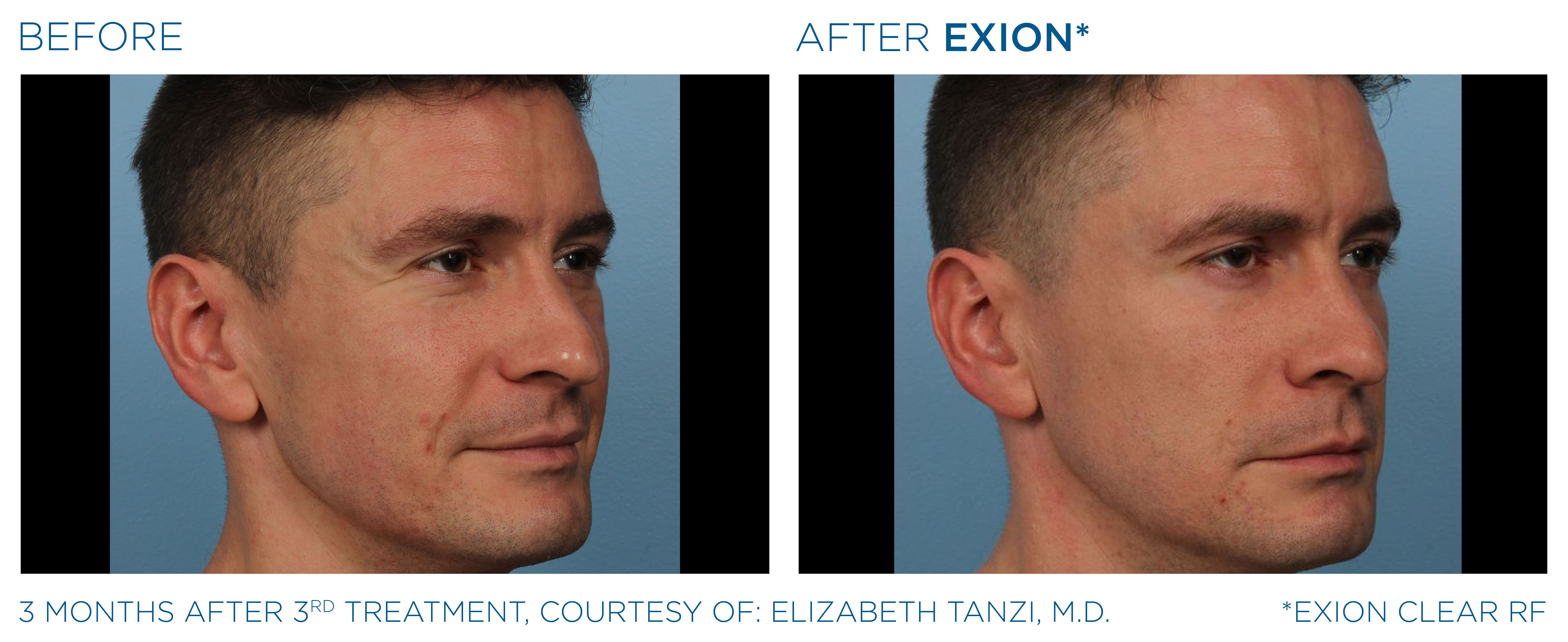 BTL-provided facial before-and-after comparison three months after the third EXION Clear RF treatment