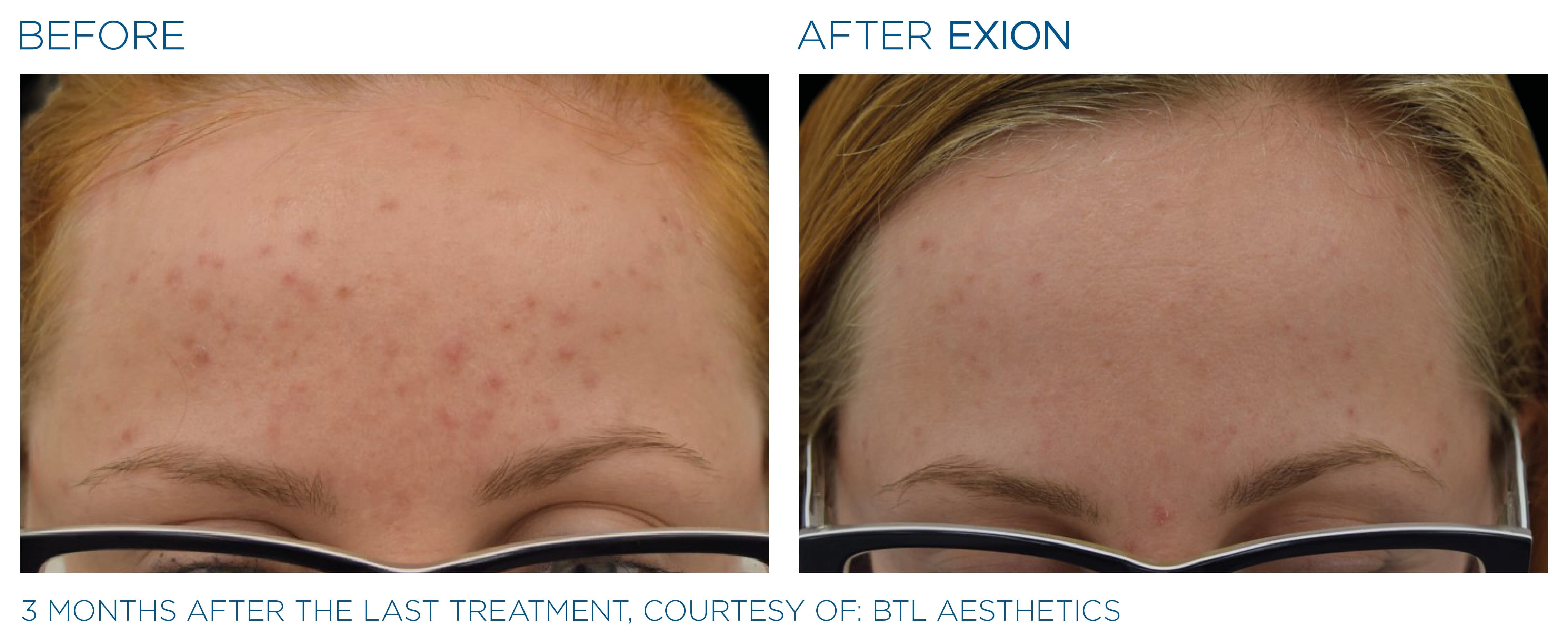 BTL-provided forehead before-and-after comparison three months after the last EXION treatment