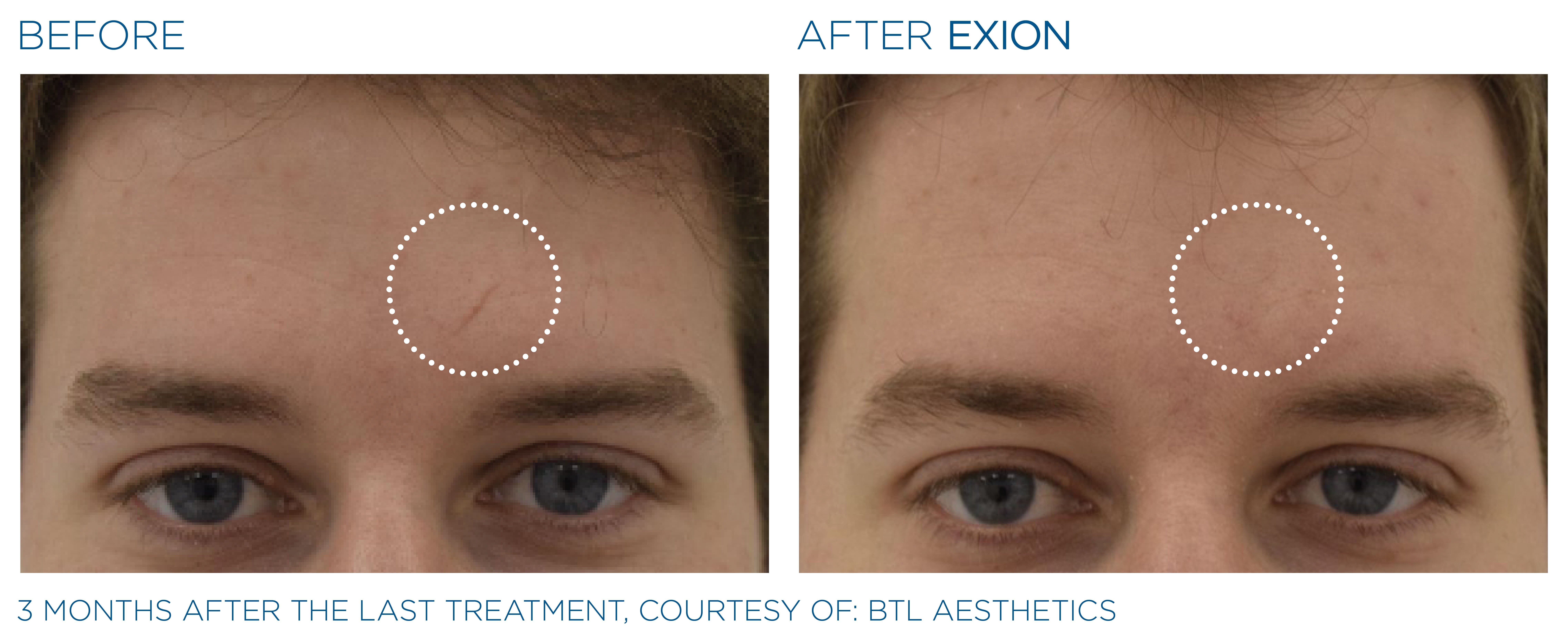 BTL-provided localized forehead before-and-after comparison three months after the last EXION treatment