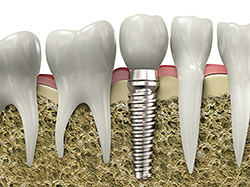 Model showing a dental implant supporting a replacement tooth