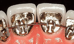 Lingual braces attached behind the teeth