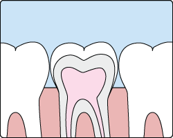 Cross-section illustration of a back tooth protected by dental sealant in its deep chewing groove