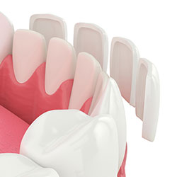 Illustration showing thin porcelain veneers placed over the front of teeth